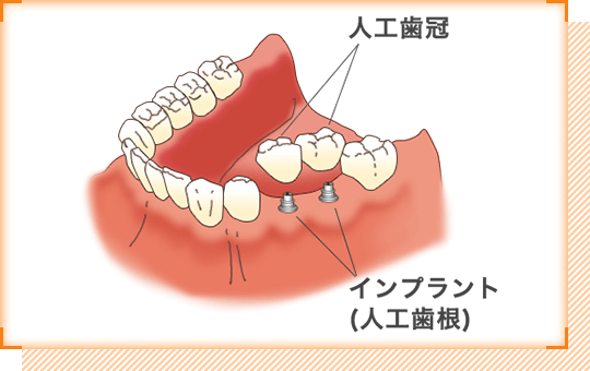 インプラント