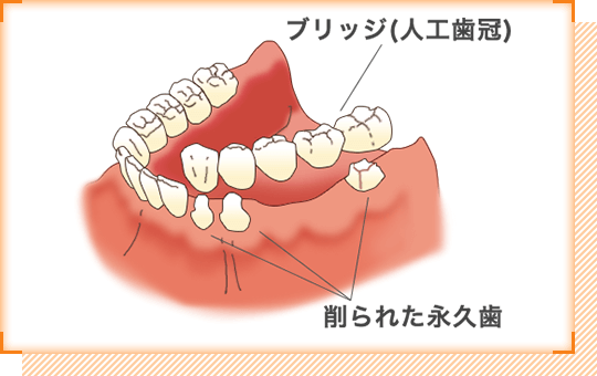 ブリッジ